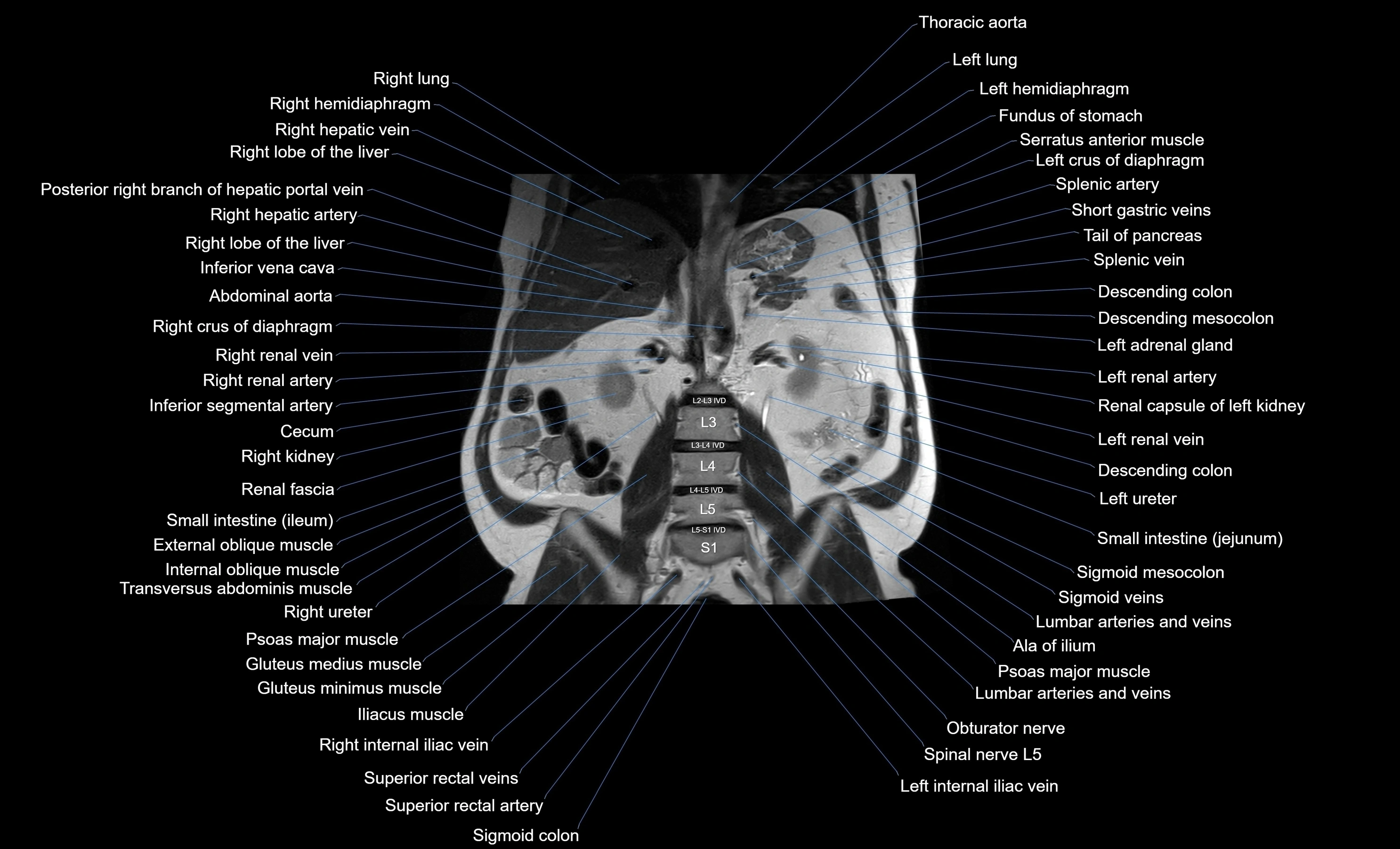 MRI Abdomen coronal labelled cross sectional anatomy radiology  image-img-00001-00035.webp
